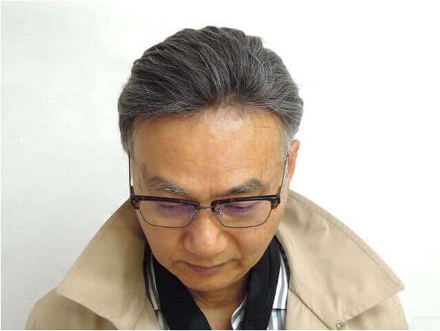 サイドバックスタイル|福岡・博多のかつら・増毛スタイル実例(グッドジョブヘア)