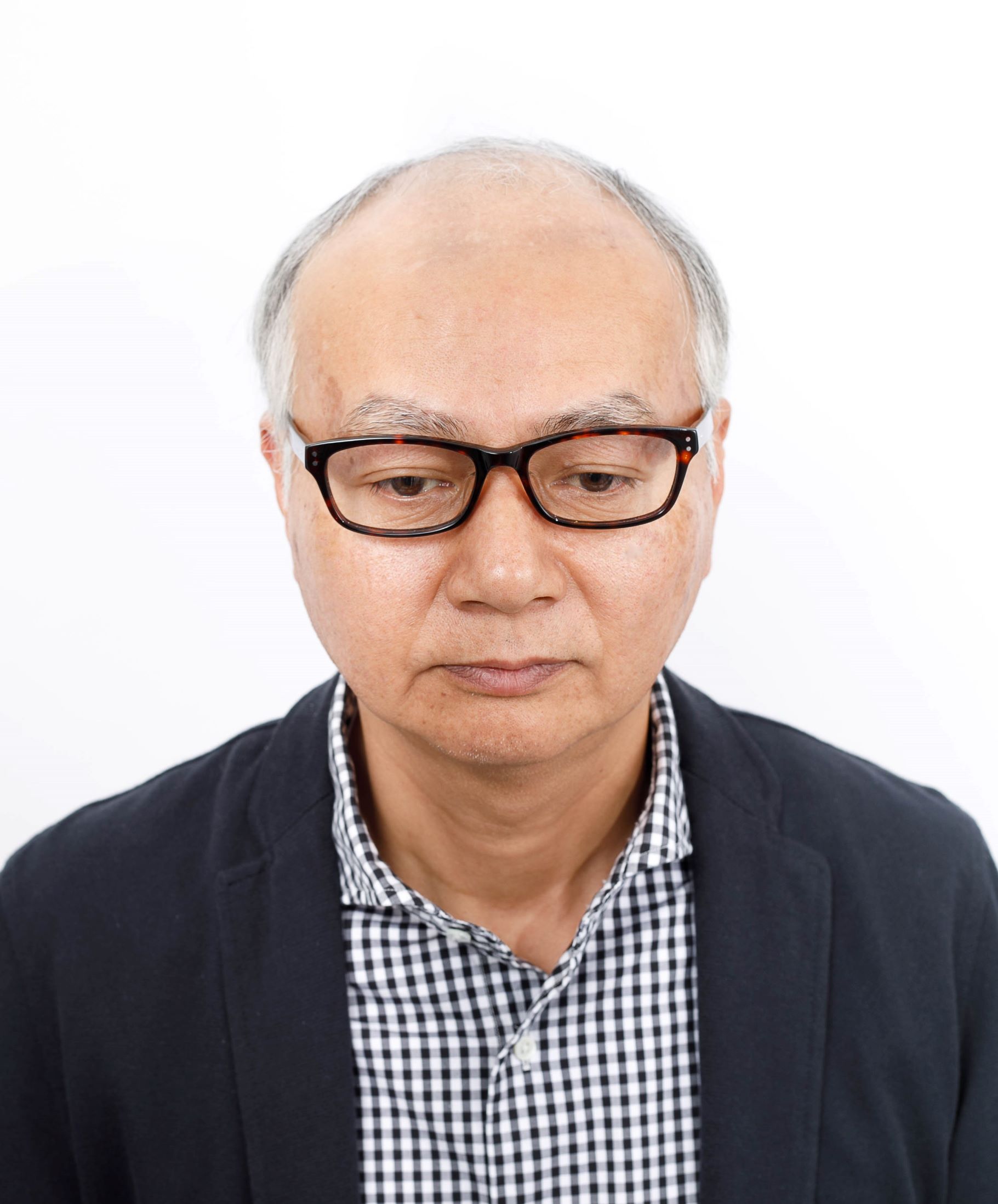 施術前:前頭部から頭頂部にかけて地肌が見える白髪まじりの男性(正面)