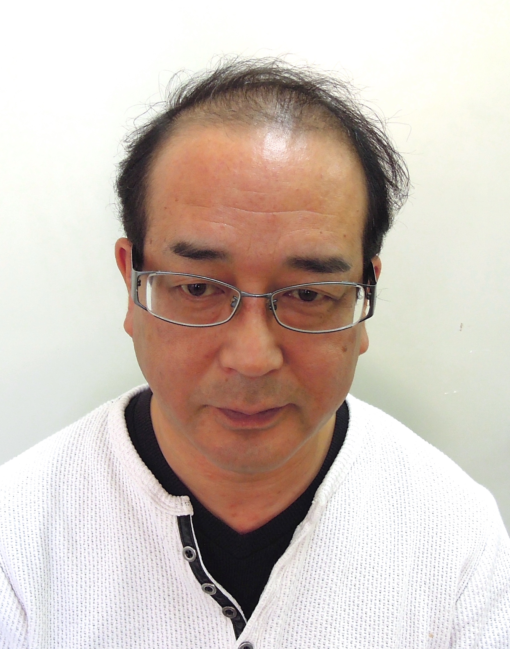 施術前:生え際が後退し前頭部の地肌が見える黒髪の男性(正面)