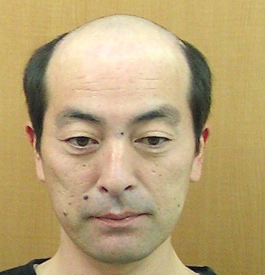 施術前:前頭部から頭頂部まで広く地肌が見える黒髪の男性(正面)