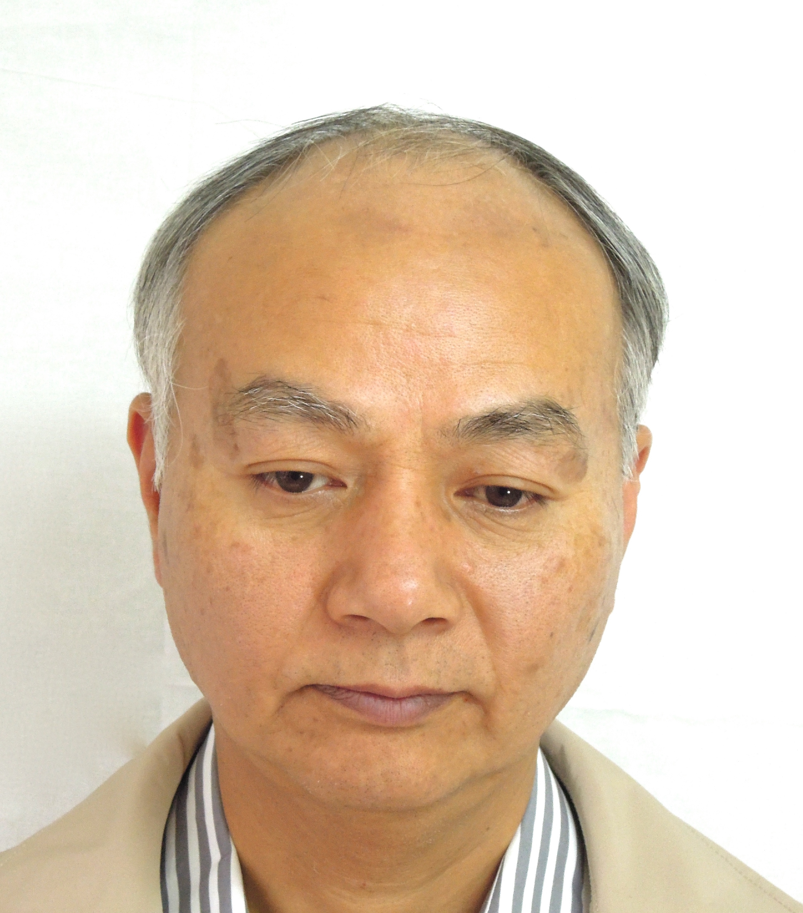 施術前:生え際が後退し額が広く見える白髪まじりの男性(正面)