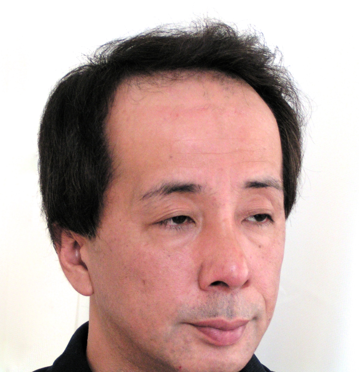施術前:生え際が後退して額が広く見える黒髪の男性(斜め)