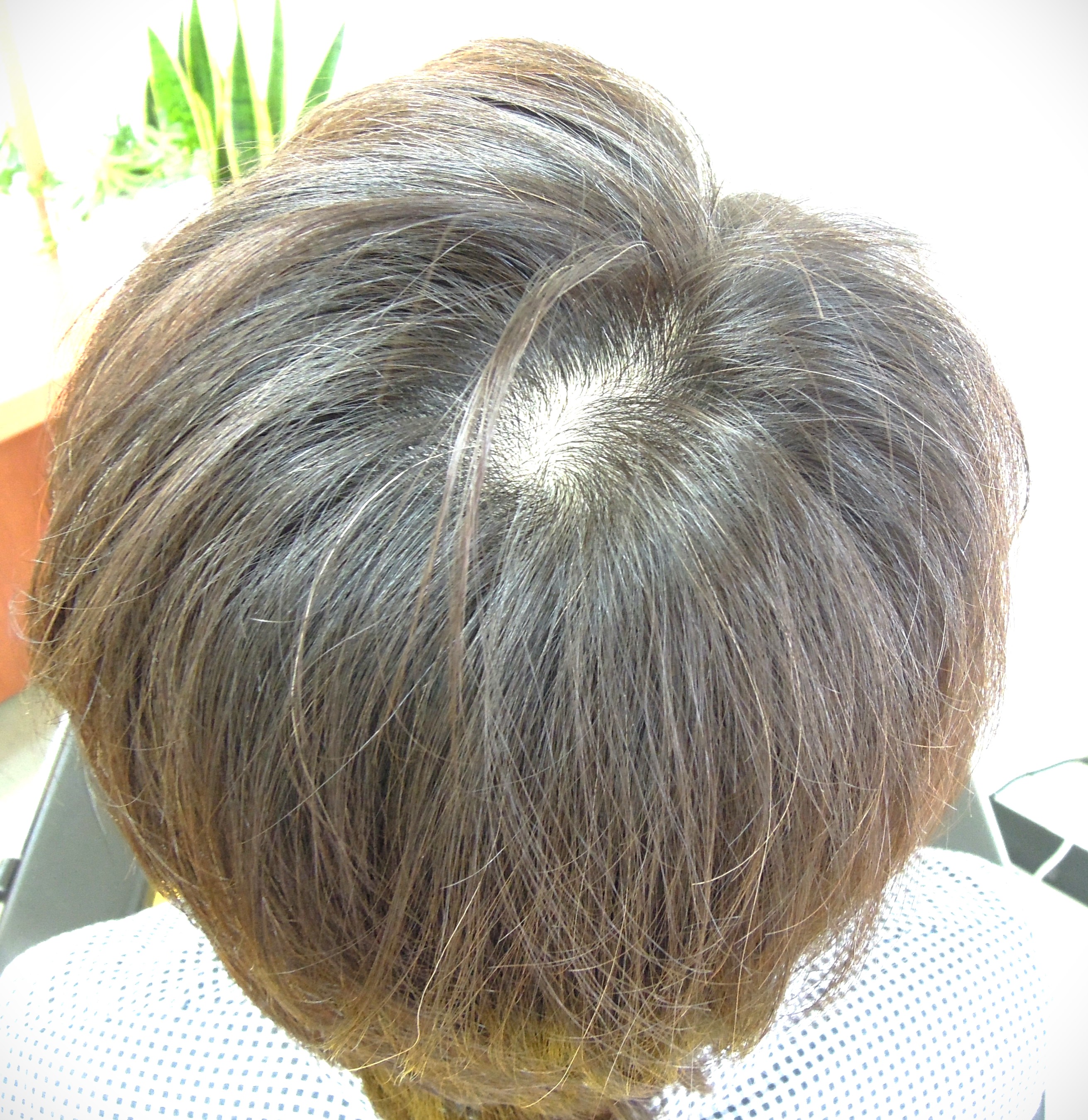 施術前:分け目とつむじ周辺の地肌が目立つ白髪まじりの頭頂部(真上から撮影)