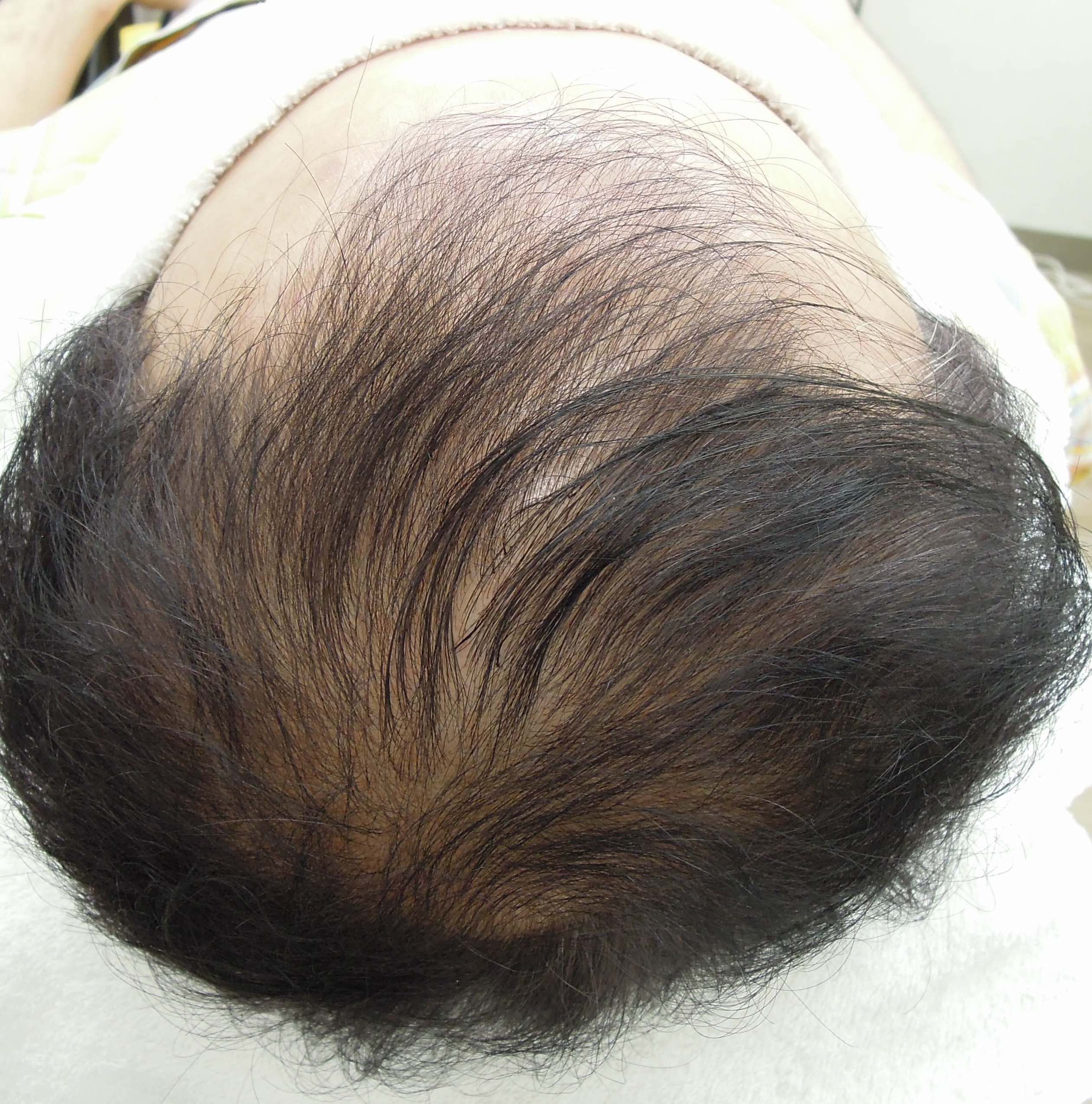 施術前:前頭部から頭頂部にかけて地肌が大きく見える黒髪(真上から撮影)